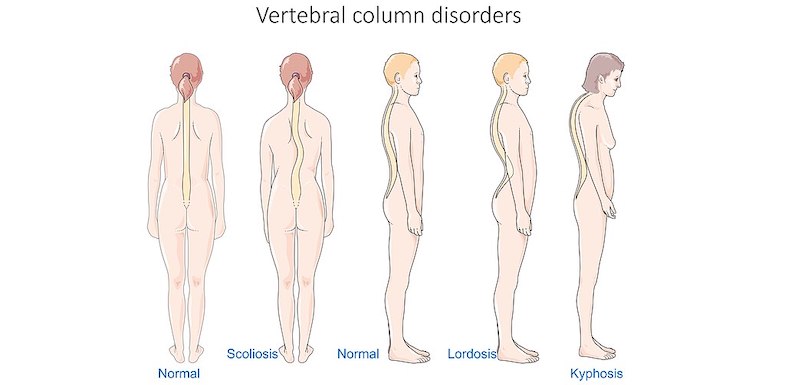 scoliosis