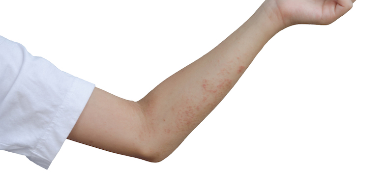 shingles rash