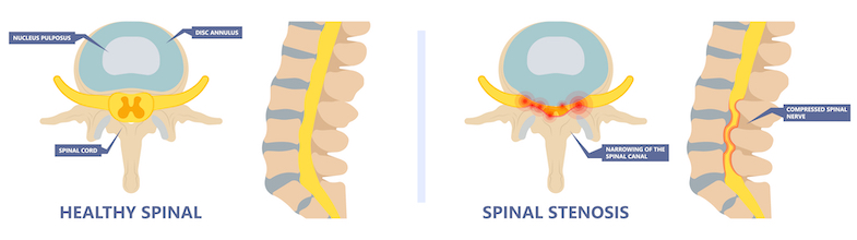 spinal stenosis