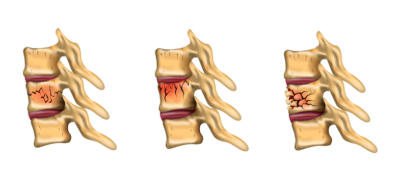 types of compression fractures