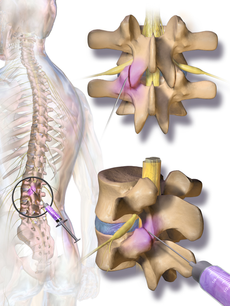 File:Blausen 0391 FacetJointInjection.png