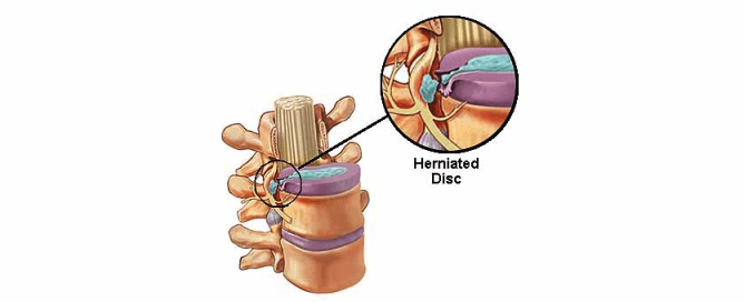 disc herniation